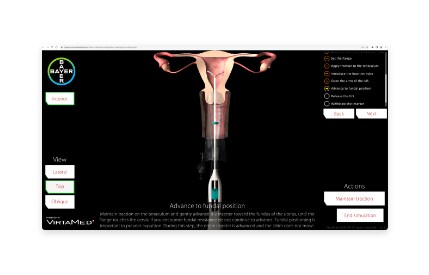 Web-based Simulator for Bayer IUDs Web-based Simulator for Bayer IUDs